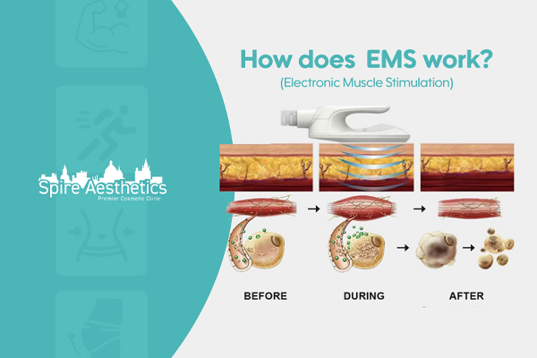 EMS treatment for post pregnancy weight loss treatment Hucknall under Huthwaite