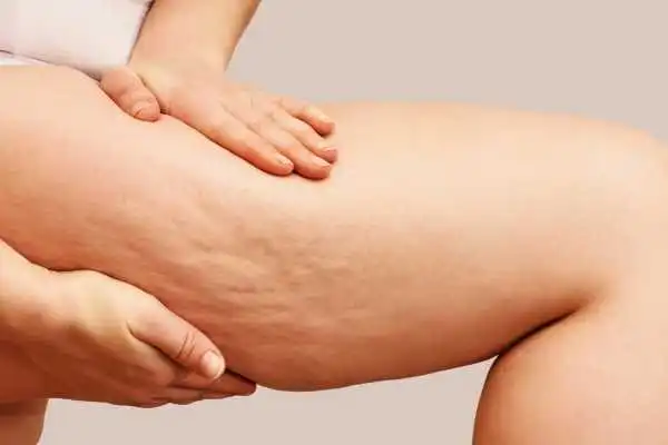 Image of woman showing leg with cellulite Hucknall under Huthwaite