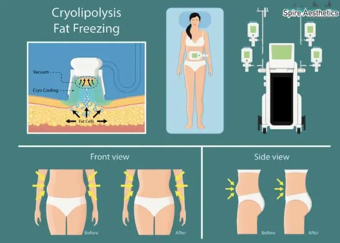 Fat freezing treatment Hucknall under Huthwaite benefits for competitions to remove stubborn fat deposits.