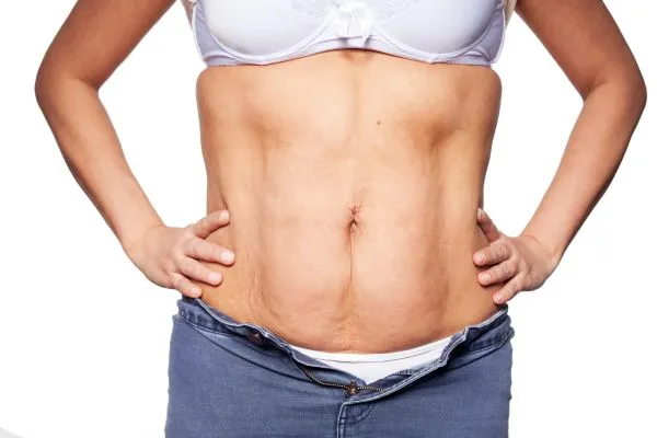 sagging skin on woman's stomach after weight loss injections Hucknall under Huthwaite