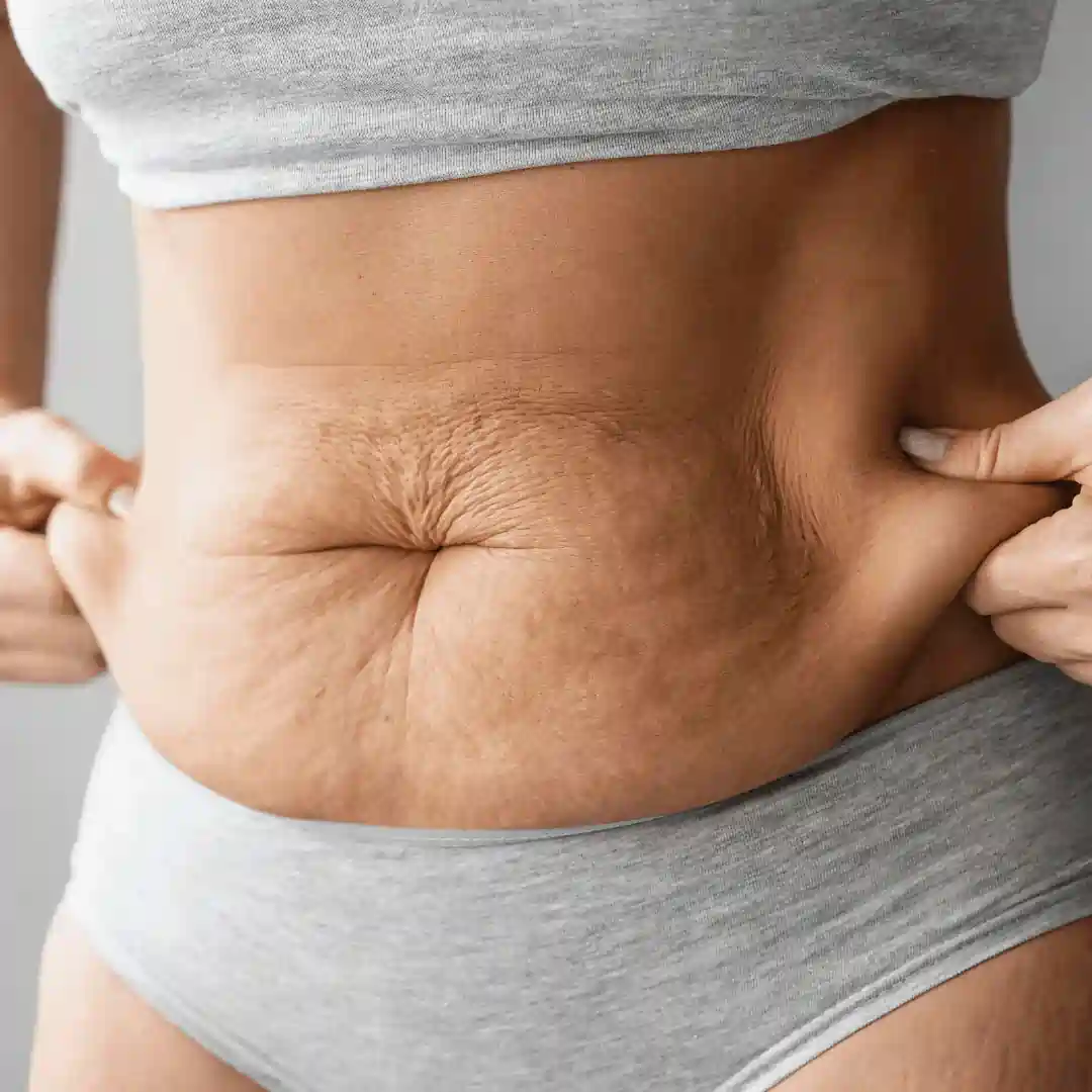 Is It Normal to Have Loose Skin After Pregnancy Hucknall under Huthwaite?