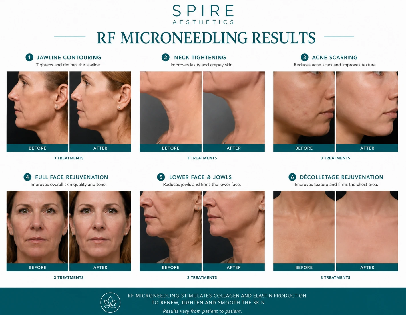 RF Microneedling Skin tightening Hucknall under Huthwaite results