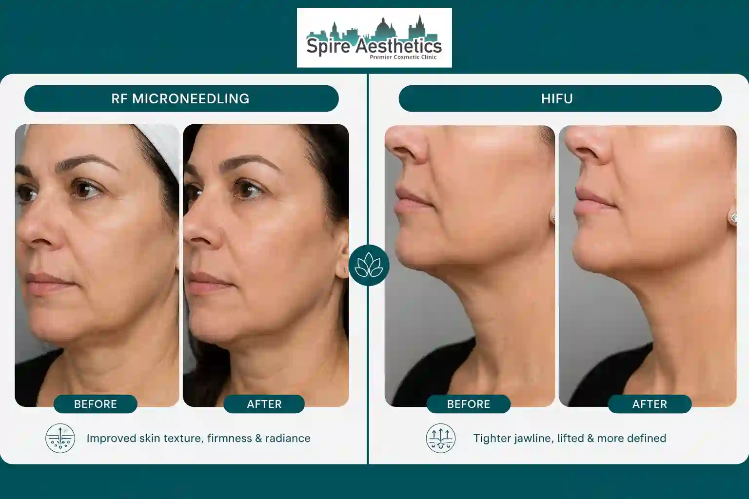 Can RF Microneedling and HIFU Be Combined Hucknall under Huthwaite?