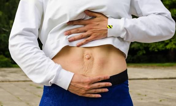 When Could Diastasis Recti Be the Missing Piece of the Puzzle Hucknall under Huthwaite?