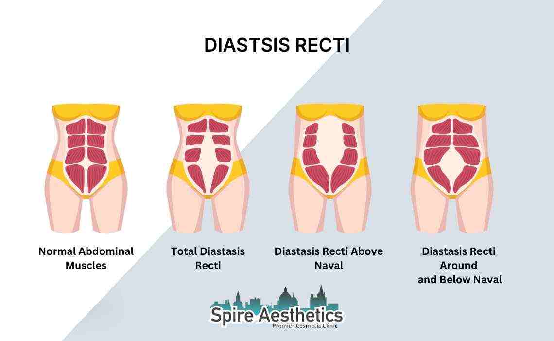 Is Non-Surgical Diastasis Recti Treatment Right for You? Common Concerns Answered Hucknall under Huthwaite